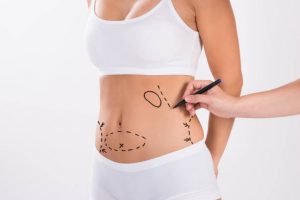 201 300x200 - What to Expect After a Tummy Tuck
